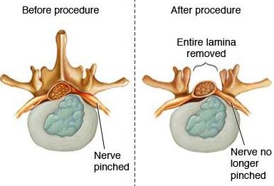 Laminectomy Image